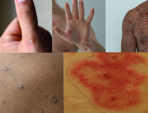 Monkeypox Virus: What Community Members Need to Know